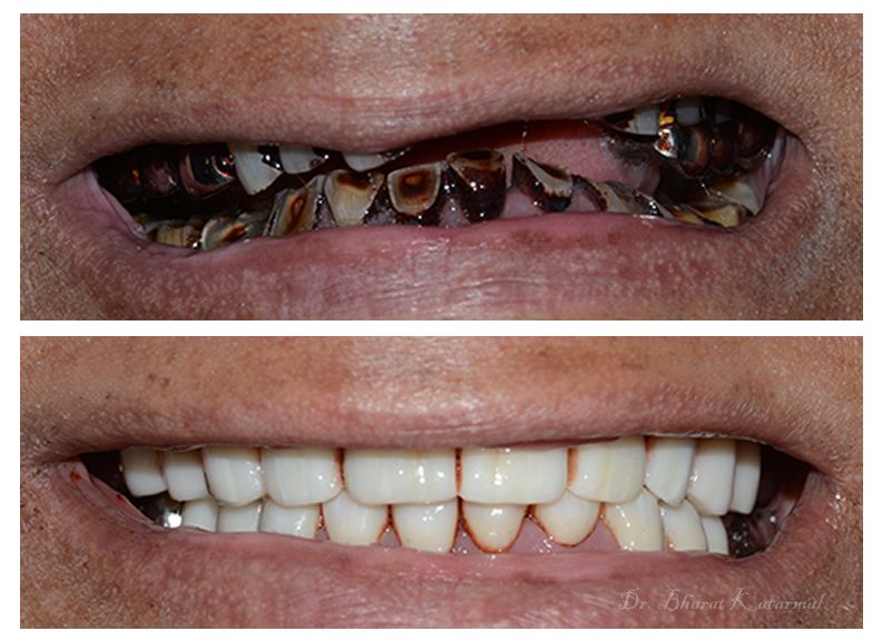 Full Mouth Rehabilitation